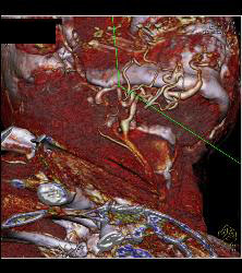 Multiple Views of An Arteriovenous Malformation (AVM) At the Angle of the Mandible - CTisus CT Scan