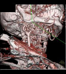 Multiple Views of An Arteriovenous Malformation (AVM) At the Angle of the Mandible - CTisus CT Scan