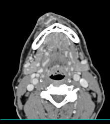 Multiple Views of An Arteriovenous Malformation (AVM) At the Angle of the Mandible - CTisus CT Scan