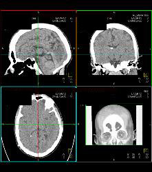 New Filter to Improve Head CT Scans - CTisus CT Scan