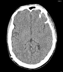 New Filter to Improve Head CT Scans - CTisus CT Scan