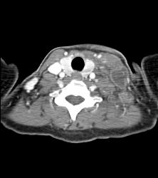 Tuberculosis (TB) With Cystic Nodes in Supraclavicular Zone - CTisus CT Scan