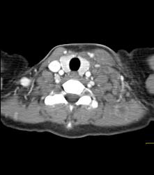 Tuberculosis (TB) With Cystic Nodes in Supraclavicular Zone - CTisus CT Scan