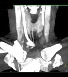 Ectopic Parathyroid Adenoma- on Left - CTisus CT Scan