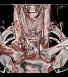 Ectopic Parathyroid Adenoma- on Left - CTisus CT Scan