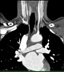 Ectopic Parathyroid Adenoma- on Left - CTisus CT Scan