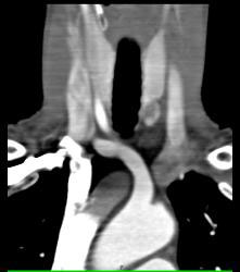 Ectopic Parathyroid Adenoma- on Left - CTisus CT Scan