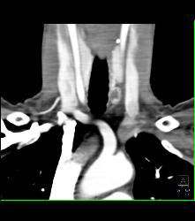 Ectopic Parathyroid Adenoma- on Left - CTisus CT Scan