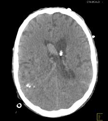 Intracranial Bleed With Mass Effect - CTisus CT Scan