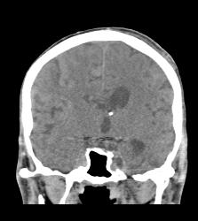 Intracranial Bleed With Mass Effect - CTisus CT Scan