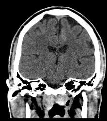 Intracranial Bleed With Mass Effect - CTisus CT Scan