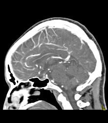 Intracranial Bleed With Mass Effect - CTisus CT Scan