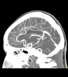 Intracranial Bleed With Mass Effect - CTisus CT Scan