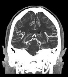 Intracranial Bleed With Mass Effect - CTisus CT Scan