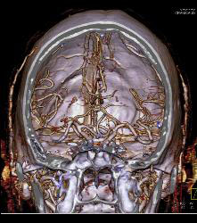 Circle of Willis - CTisus CT Scan