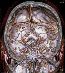 Circle of Willis - CTisus CT Scan