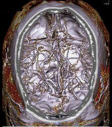 Circle of Willis - CTisus CT Scan