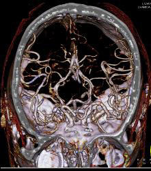 Circle of Willis - CTisus CT Scan