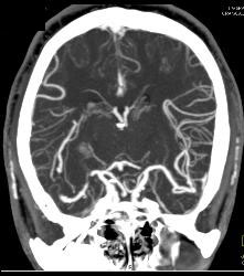 Circle of Willis - CTisus CT Scan