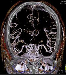 Circle of Willis - CTisus CT Scan