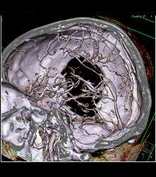 Circle of Willis - CTisus CT Scan