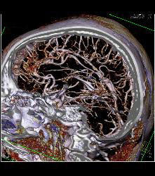 Circle of Willis - CTisus CT Scan