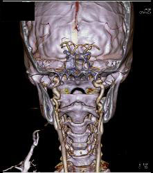 Circle of Willis - CTisus CT Scan