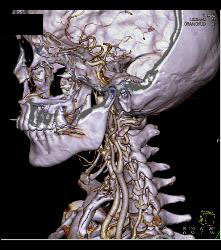 Circle of Willis - CTisus CT Scan