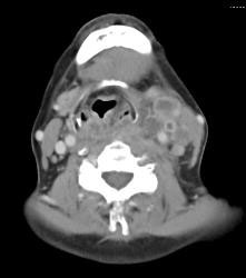 Cystic Nodes Due to Tuberculosis (TB) - CTisus CT Scan