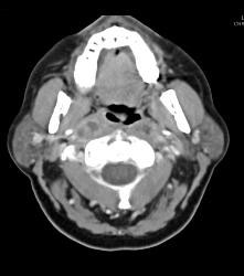 Cystic Nodes Due to Tuberculosis (TB) - CTisus CT Scan