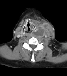 Abscess - CTisus CT Scan