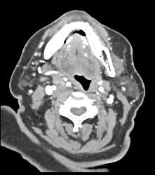 Abscess - CTisus CT Scan