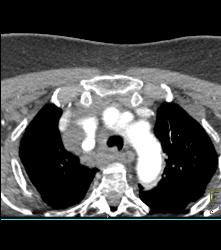 Lymphoma - CTisus CT Scan