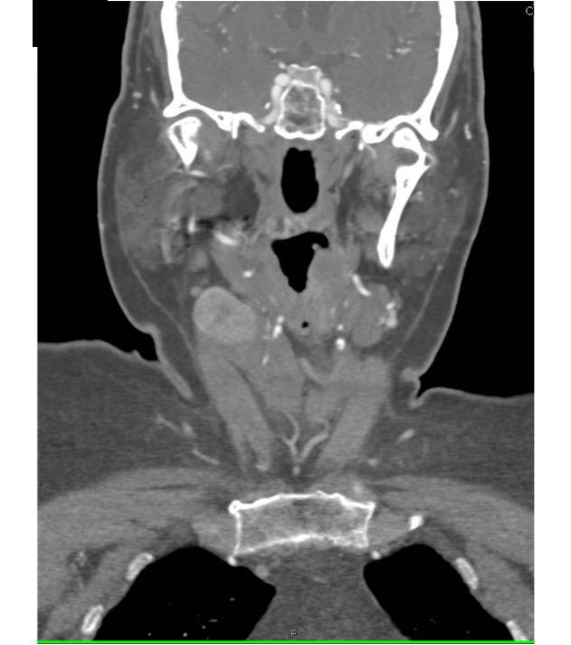 Thyroid Carcinoma - CTisus CT Scan