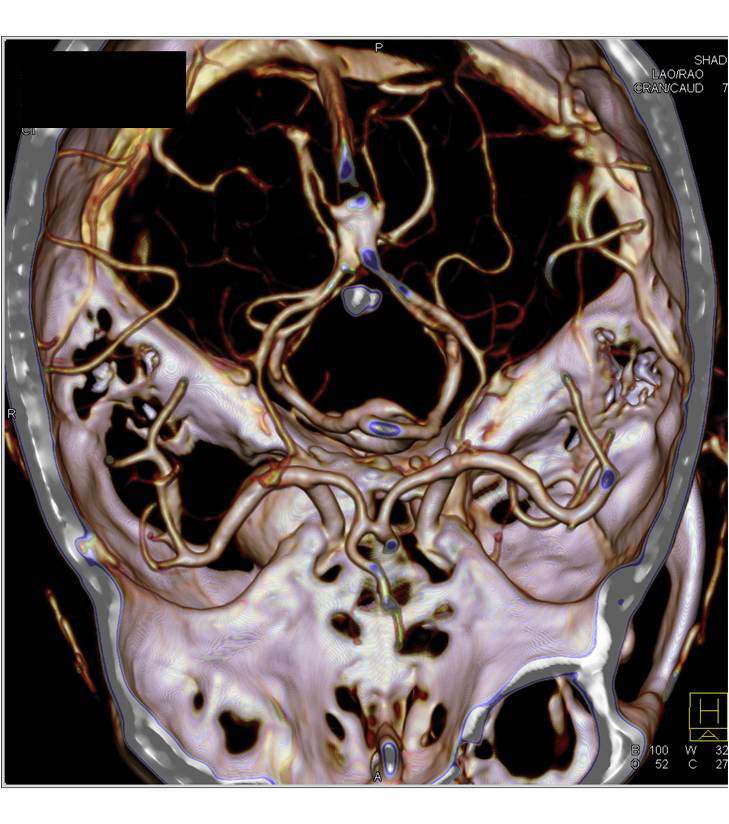 Circle of Willis Aneurysm - CTisus CT Scan