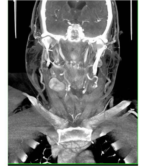 CTA Neck with Mass in Right Neck Using Color Mapping - CTisus CT Scan