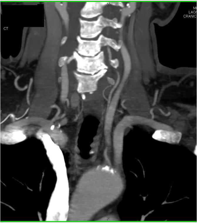 CTA Mapping of the Carotid and Vertebral Arteries - CTisus CT Scan