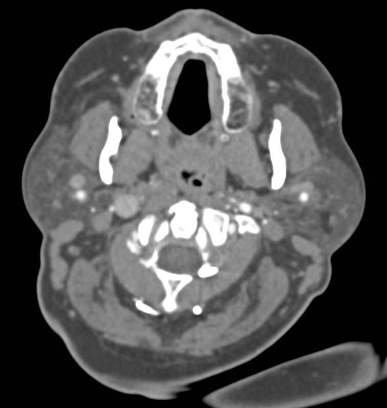 Retroaortic Left Renal Vein - CTisus CT Scan