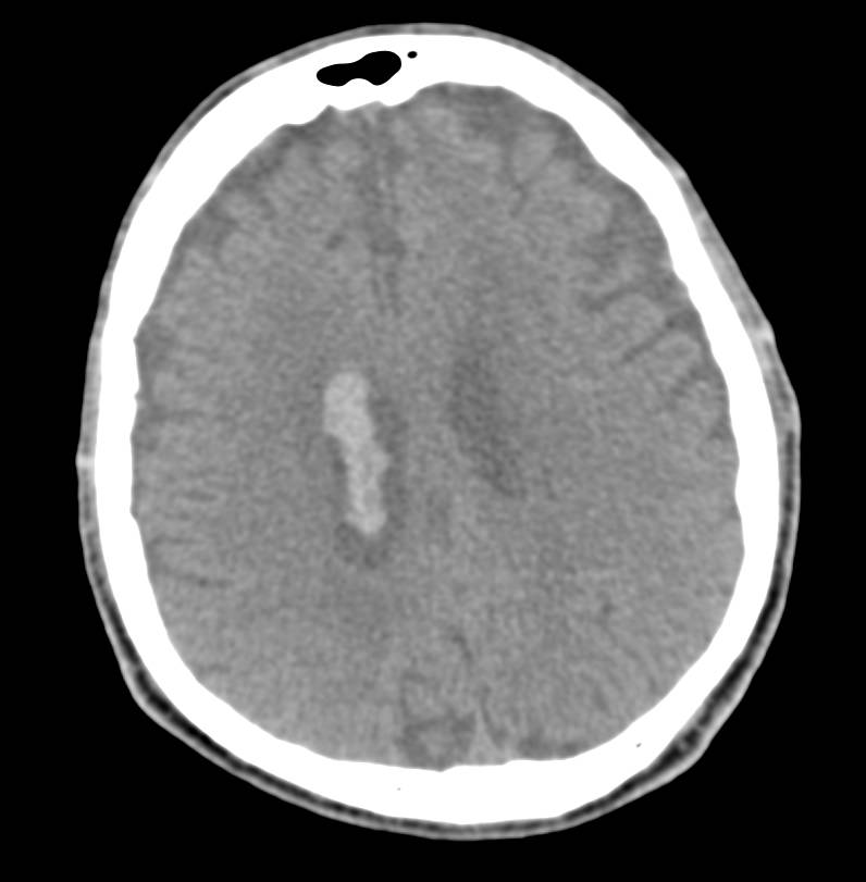 Intracranial Bleed with Blood in Ventricle - Neuro Case Studies ...