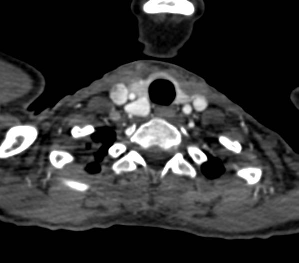 Unusual Carotid Artery Aneurysm - CTisus CT Scan