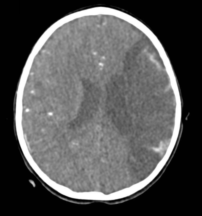 Intracranial Bleed - CTisus CT Scan