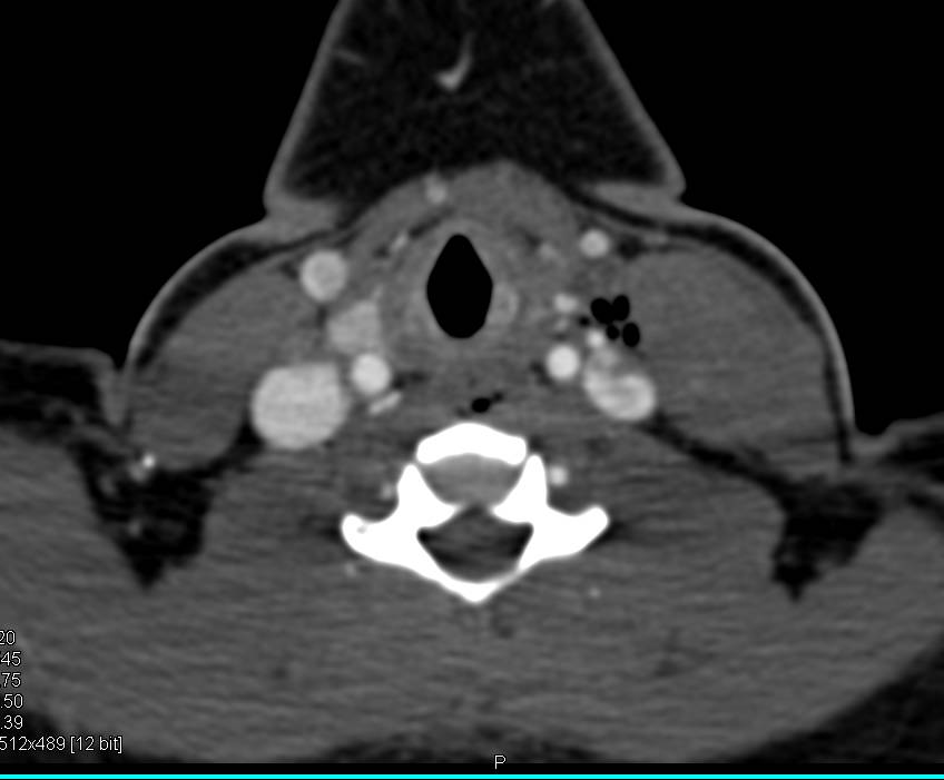 3D Mapping of a Right Sided Parathyroid Adenoma - CTisus CT Scan