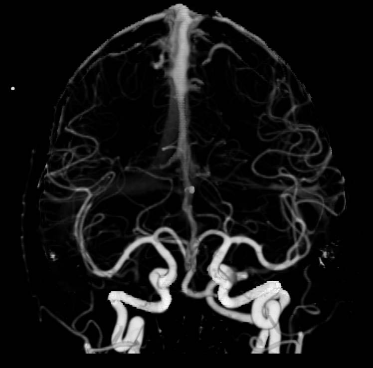 CTA of Circle of Willis Comparing Dual Energy Bone Removal Versus Autobone Removal. Dual Energy is Ideal for Base of Skull Editing - CTisus CT Scan