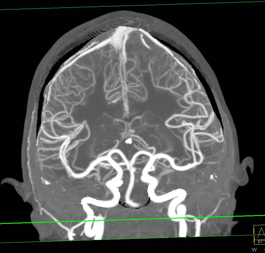 Dual Energy is Ideal for Base of Skull Editing - CTisus CT Scan.