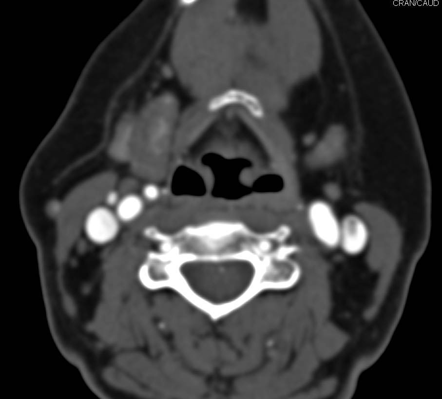 Right Sided 6 mm Parathyroid Adenoma Nicely Seen in 3D - CTisus CT Scan