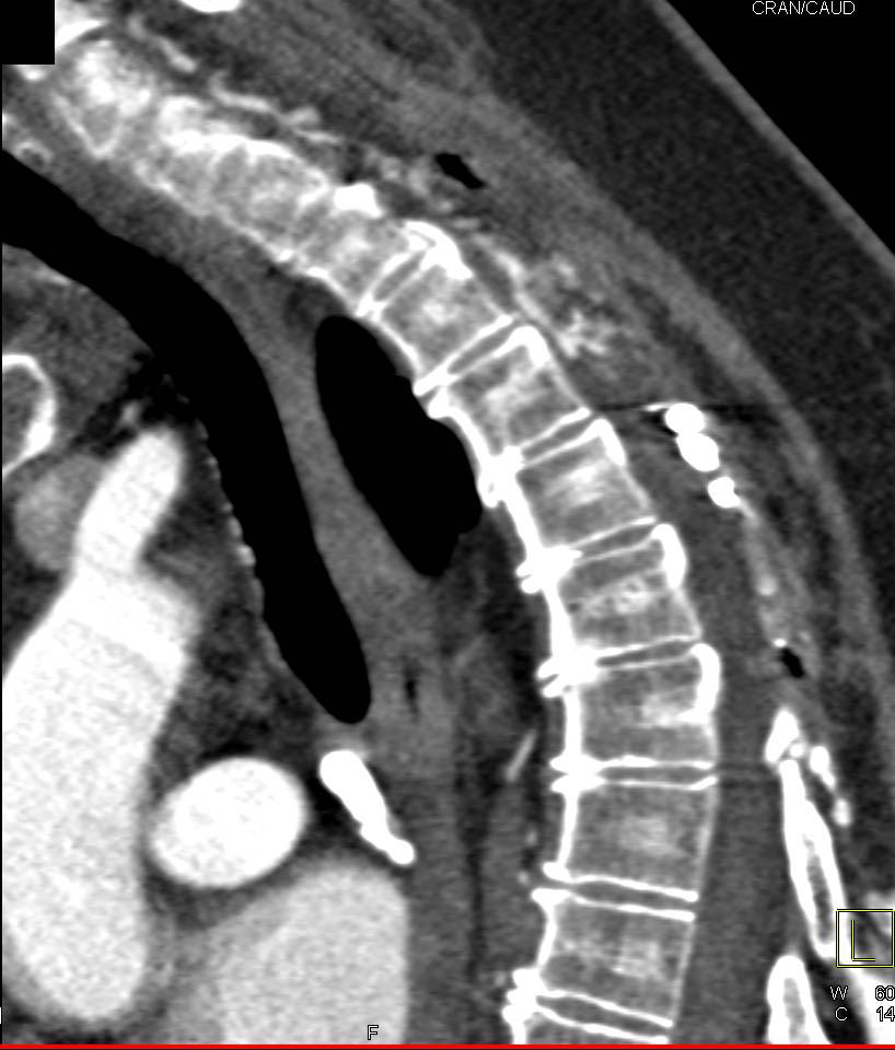 Arteriovenous Malformation (AVM) Spinal Cord - CTisus CT Scan