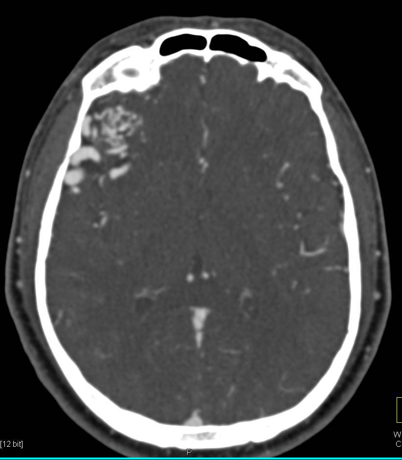 3D Display of an Intracranial Aneurysm - CTisus CT Scan