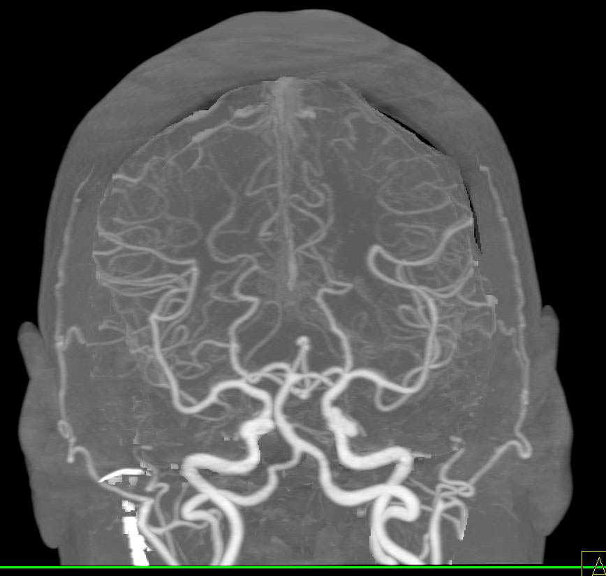 CTA Brain done with Dual Energy CT Techniques for Bone Removal - CTisus CT Scan