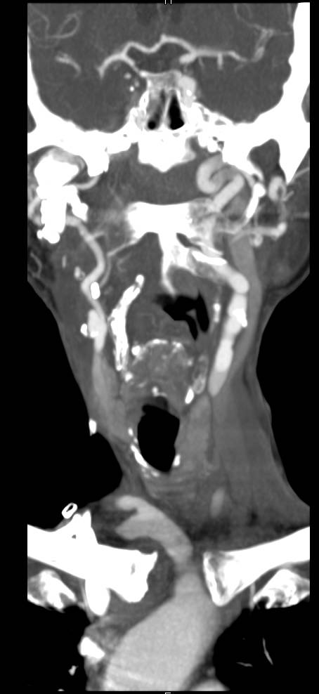 Recurrent Mandibular Tumor with Prior Reconstructive Surgery - CTisus CT Scan