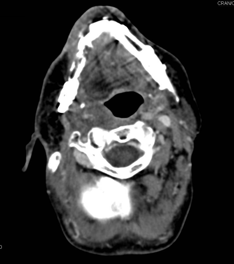 Recurrent Mandibular Tumor with CT?PET/MRI Correlation - CTisus CT Scan